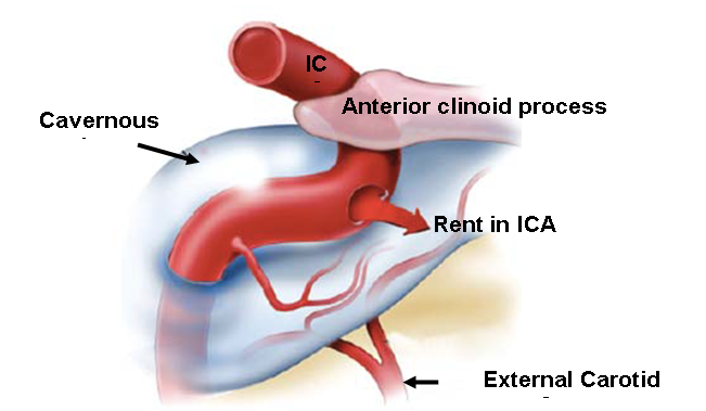 cavernous sinus fistula
